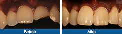 broken-tooth-treatment