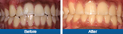 Teeth Straightening Treatment