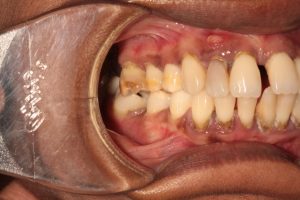 Abscessed Tooth
