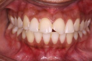 Cracked Tooth
