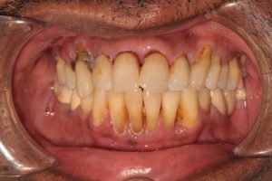 Gum Recession