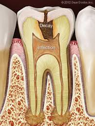 Tooth Decay