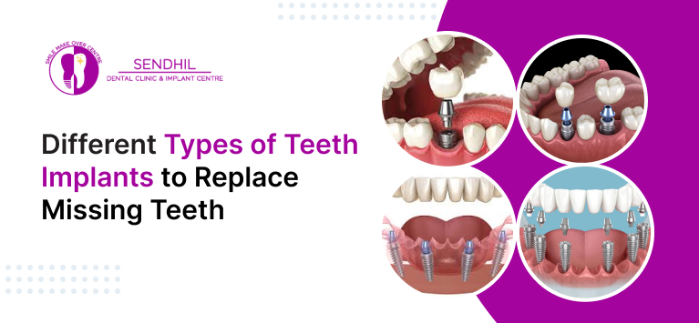 Different types of teeth implants to replace missing teeth