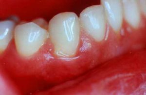 Bleeding Gums