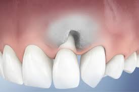 Loose tooth