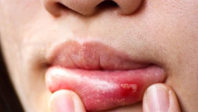 Canker Sore
