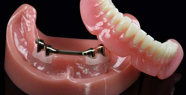 Metal bar retained implant denture