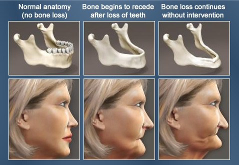 Effect of teeth bone loss