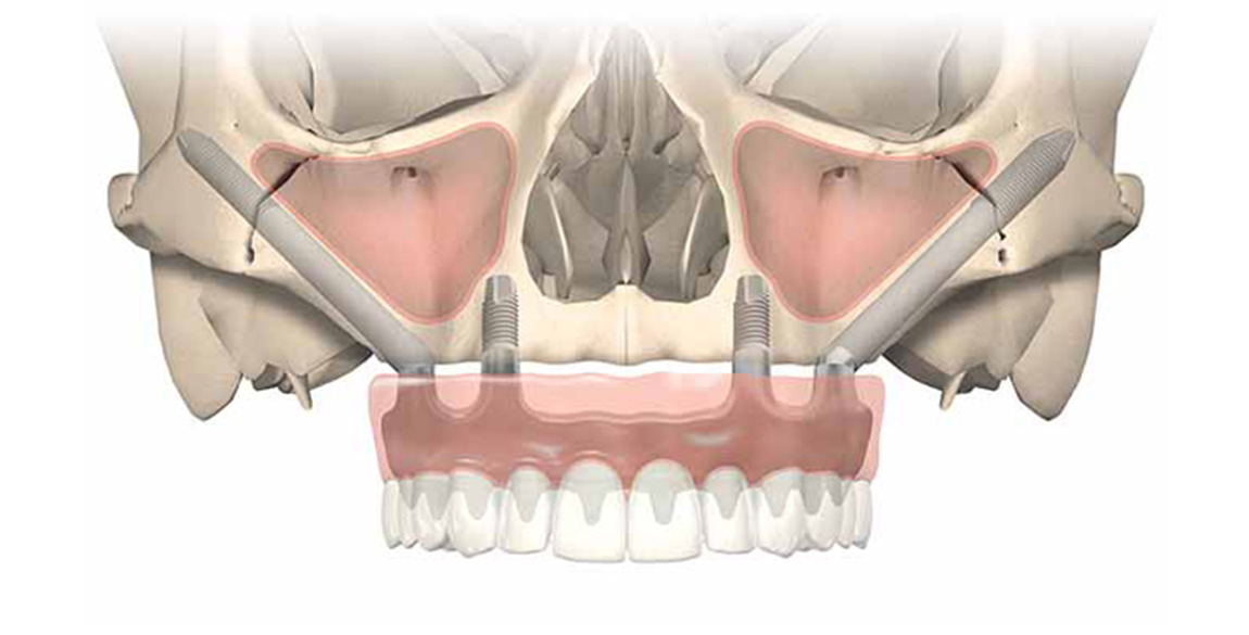 What are Zygomatic Implants