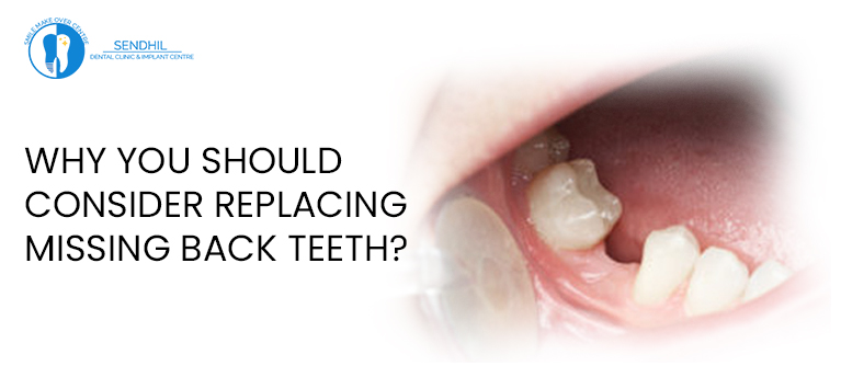 Why you should consider replacing missing back teeth?