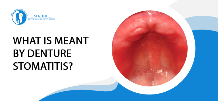 What is meant by Denture Stomatitis?