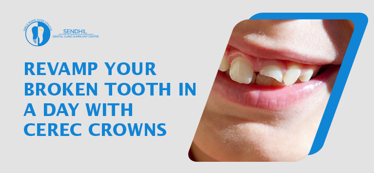 Revamp your broken tooth in a day with CEREC Crowns