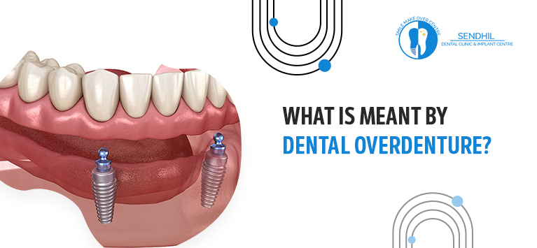What is meant by Dental Overdenture?