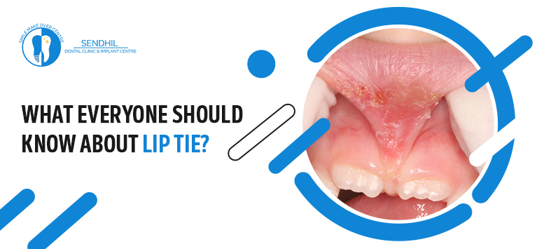 What everyone should know about lip tie?
