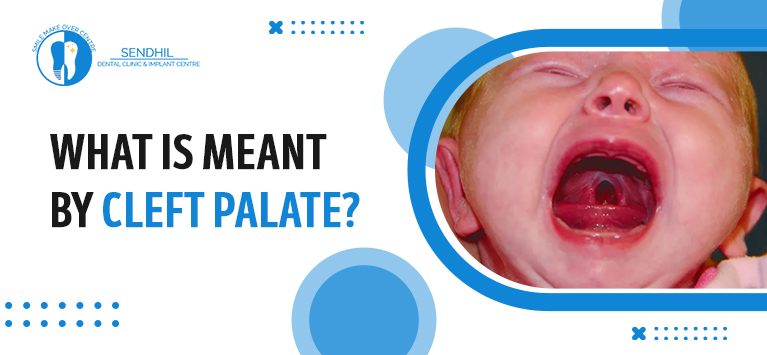 What is meant by cleft palate?