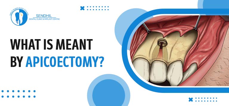What is meant by Apicoectomy?