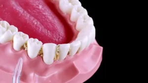 Food stuck in teeth 