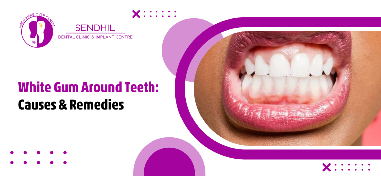 White-Gum-Around-Teeth-Causes-&-Remedies