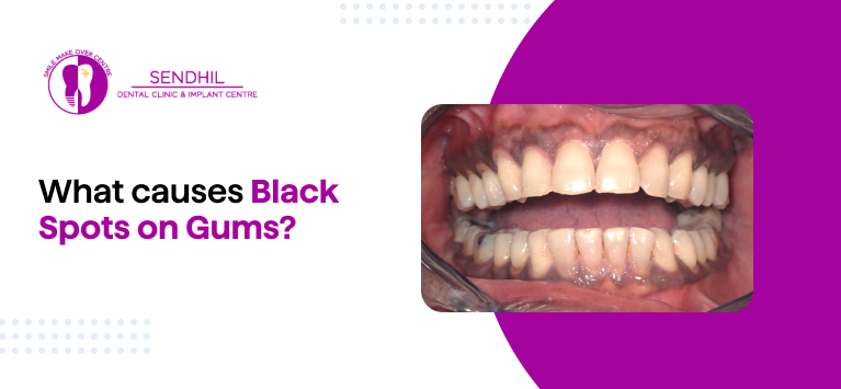 Black Spots on Gums: Causes and When to See a Dentist