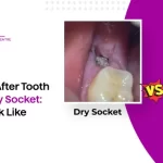 Normal socket after tooth extraction vs Dry Socket