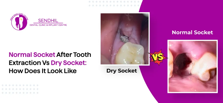 Normal socket after tooth extraction vs Dry Socket