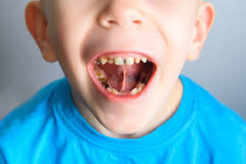 Tooth decay pictures