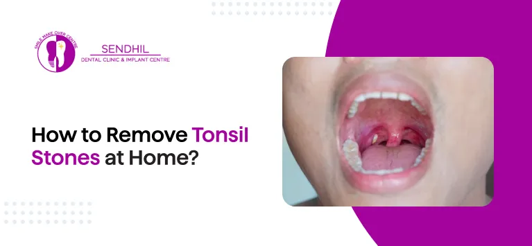 How to Remove Tonsil Stones at Home?