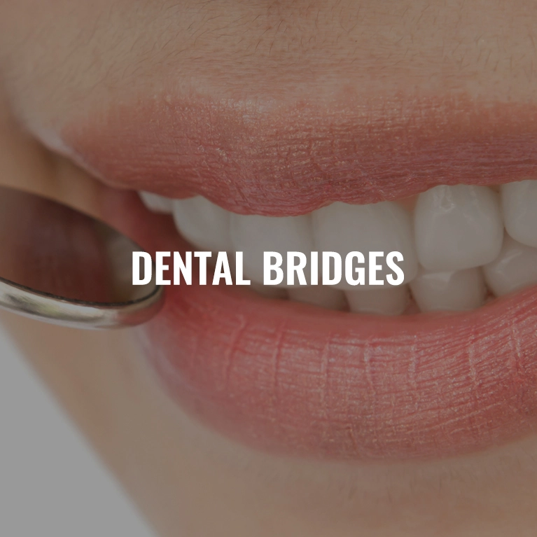 Dental Bridges in Chennai