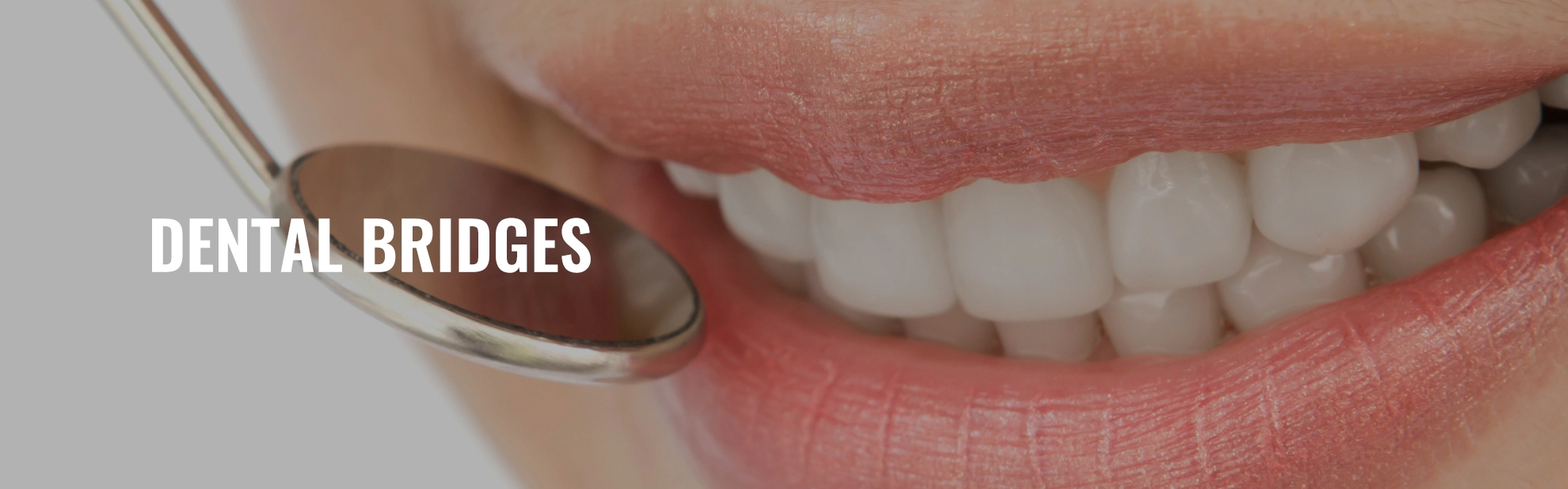 Dental Bridges in Chennai