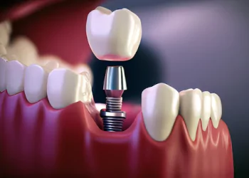 Dental Implant