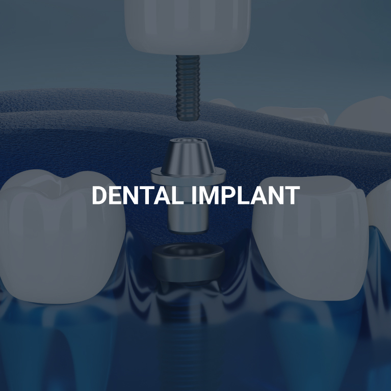 Dental Implants in Chennai