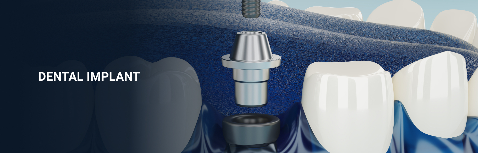 Dental Implants in Chennai