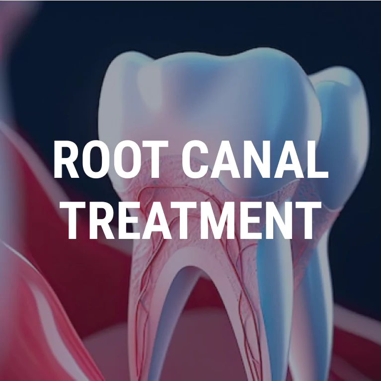 Root Canal Treatment in Chennai