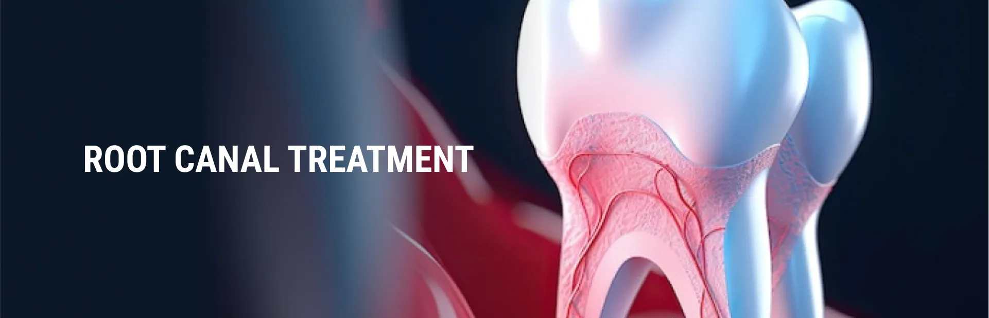 Root Canal Treatment in Chennai