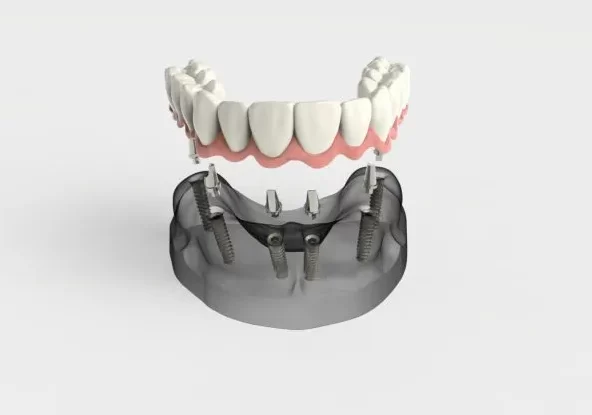 Full mouth dental implants in Chennai