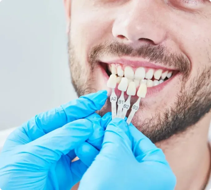 Best Dental Veneers in Chennai