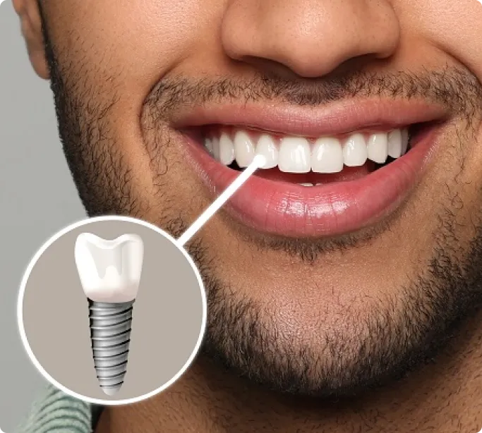 Dental Implants in Chennai