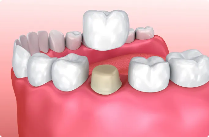 Dental Crowns in Chennai