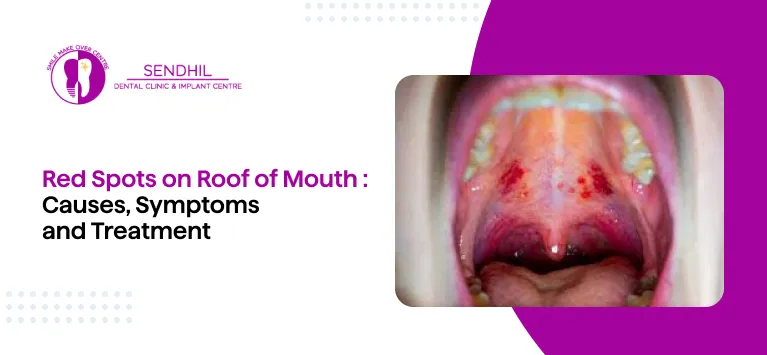 Red Spots on Roof of Mouth: Causes, Symptoms and Treatment