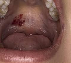 pictures of red spots on roof of mouth