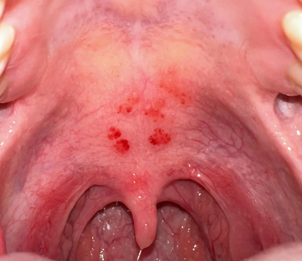 pictures of red spots on roof of mouth