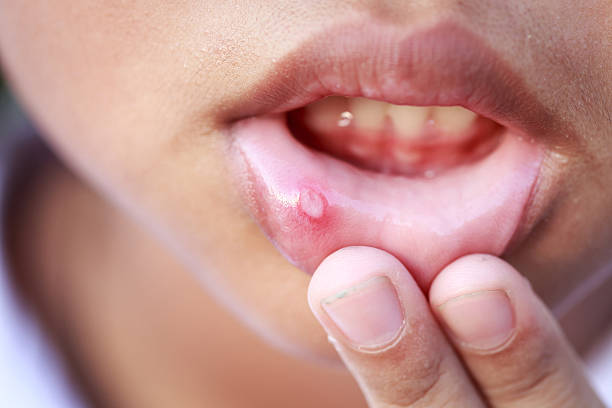 mouth ulcer images