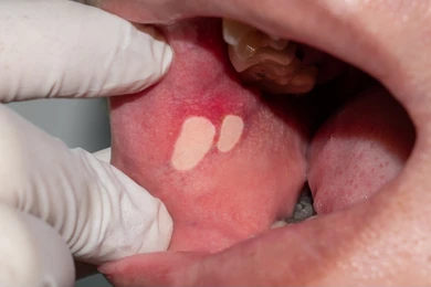 images of mouth ulcer 